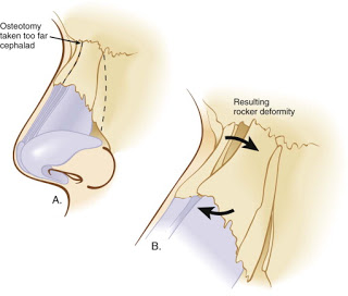 內側截骨(Medial Osteotomy)的高度朝天鼻,蒜頭鼻,韓式隆鼻,隆鼻手術