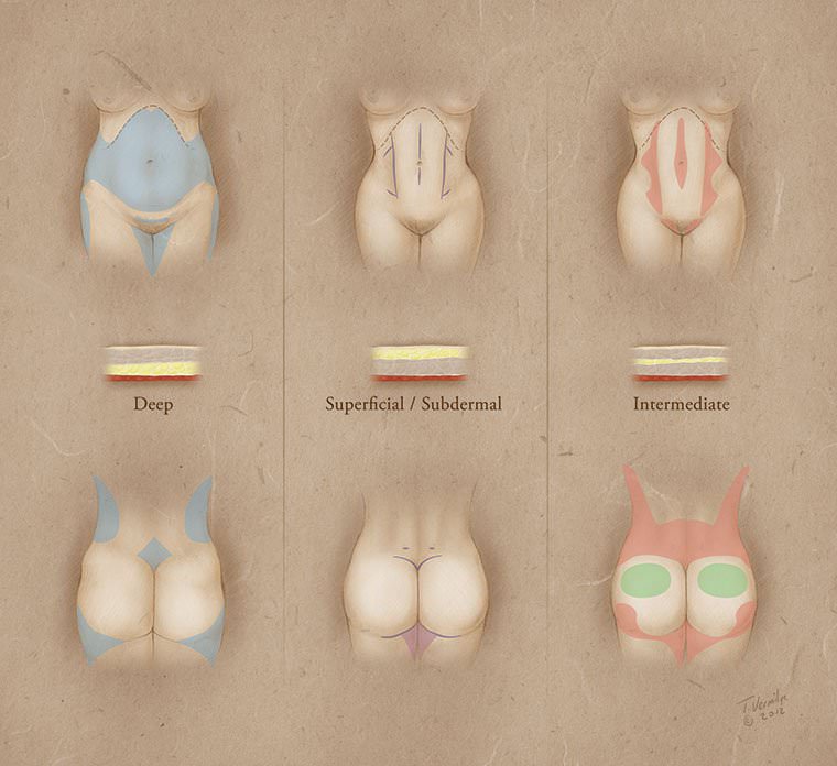 威塑(vaser)女性腹部抽脂大解密