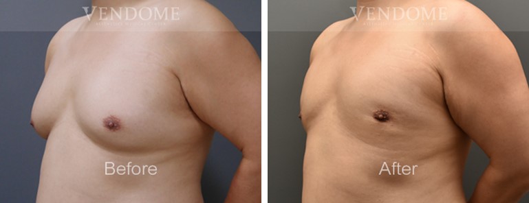 男性女乳症抽脂手術：案例分享照片