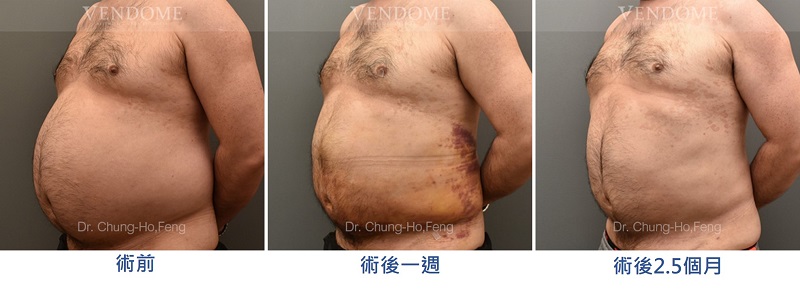 腹部抽脂手術案例照片：術後重現腰部線條