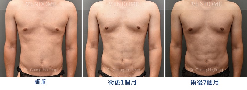 腹部抽脂手術案例照片：自然健美的六塊肌