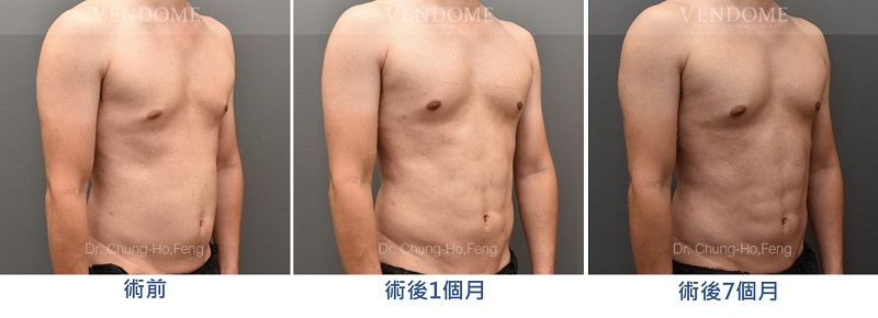 男性腹部抽脂手術案例照片：術前術後比較