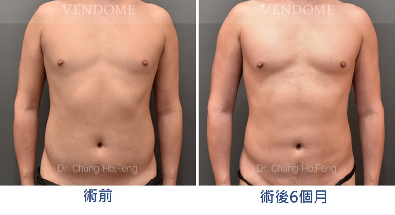 男性腹部抽脂手術：術前術後比較