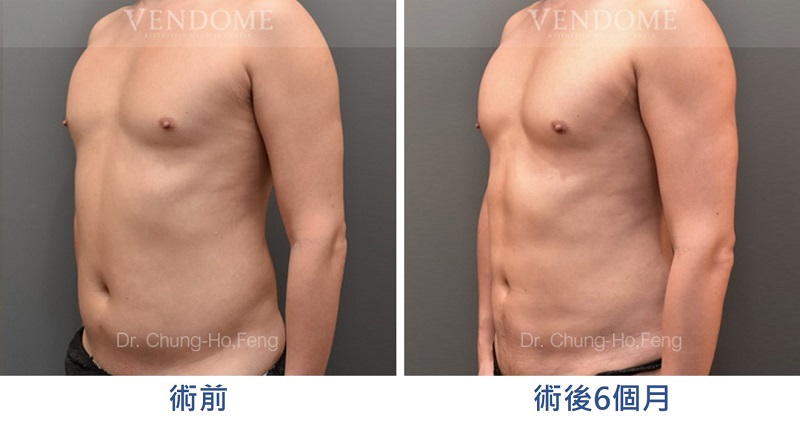 男性腹部抽脂手術：術前術後比較
