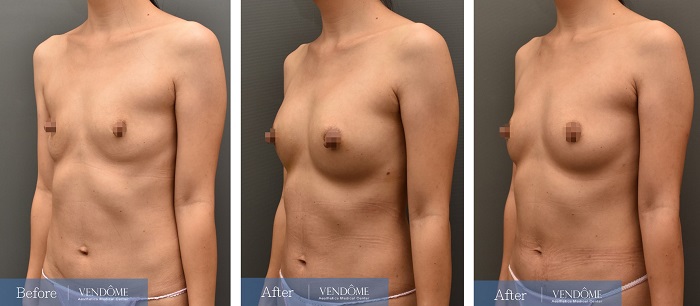 自體脂肪隆乳案例分享產後A罩杯側面照