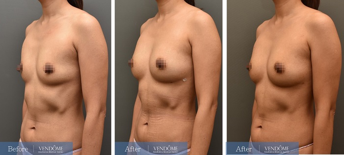 自體脂肪隆乳案例分享產後B罩杯側面照
