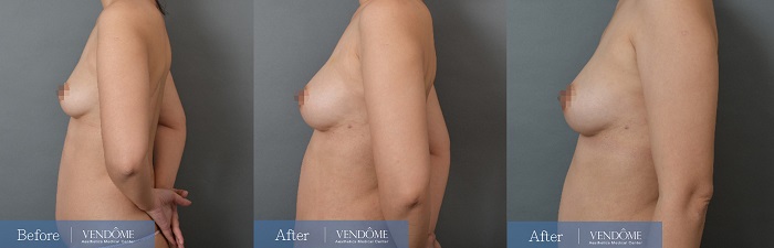 自體脂肪隆乳案例分享產後C罩杯側面照
