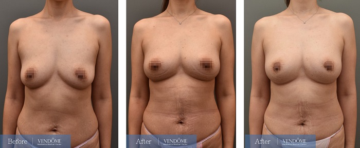 自體脂肪隆乳案例分享D罩杯乳房下垂正面照