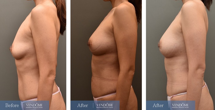自體脂肪隆乳案例分享D罩杯乳房下垂側面照