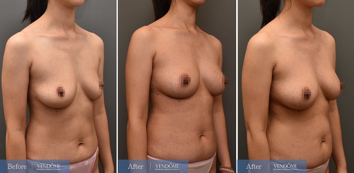 自體脂肪隆乳案例分享D罩杯乳房下垂側面照