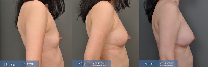 自體脂肪隆乳案例分享A罩杯側面照