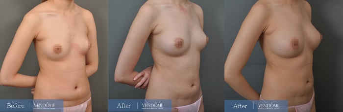 自體脂肪隆乳案例分享B罩杯側面照