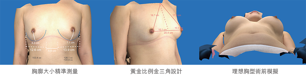 3D模擬評估自體脂肪隆乳