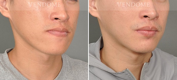 戽斗合併顏面歪斜的患者案例，實際進行正顎手術之成效前後對比。