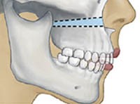 正顎手術勒福式第一型上顎切骨手術
