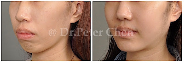 下巴後縮（短下巴）的患者，經正顎手術的前後對比，改善咬合及臉型。
