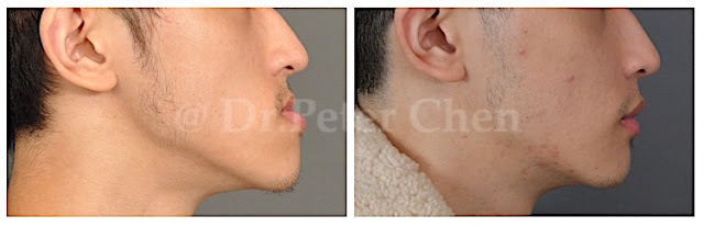 中臉凹陷合併下顎突出的患者案例，實際進行正顎手術之成效前後對比。