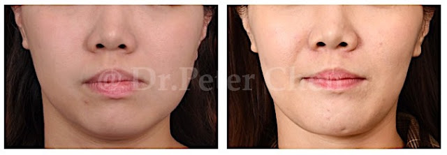顏面歪斜合併下巴後縮的患者案例，實際進行正顎手術之成效前後對比。