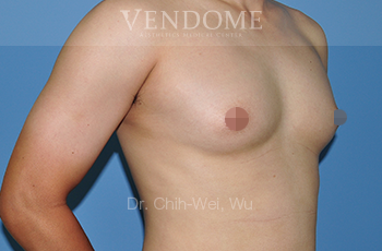 男性女乳症抽脂手術：術前案例照片