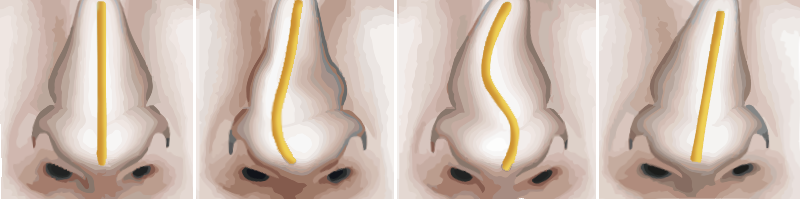 【常見鼻子整形問題】鼻樑歪斜的隆鼻手術說明