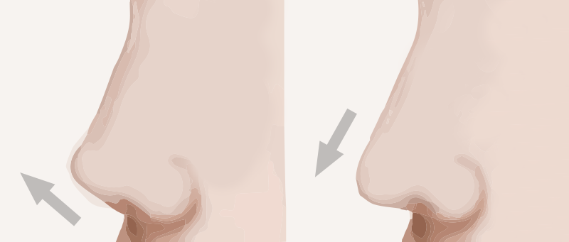 【常見鼻子整形問題】朝天鼻的隆鼻手術說明