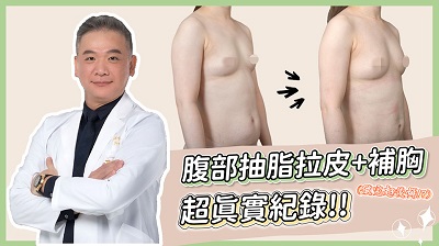 抽脂,抽脂手術,威塑抽脂,抽脂體雕,超能電漿,男性女乳