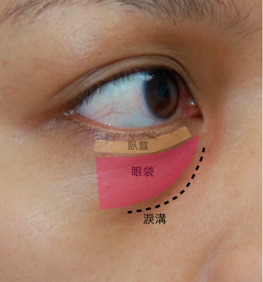 分辨眼袋、淚溝、臥蠶