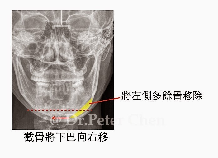 下巴手術