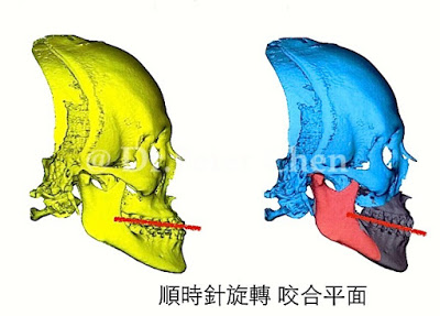 正顎手術