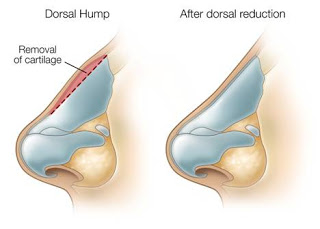 朝天鼻,蒜頭鼻,駝峰鼻,韓式隆鼻,隆鼻手術
