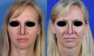 鼻骨截骨術-朝天鼻,蒜頭鼻,韓式隆鼻,隆鼻手術