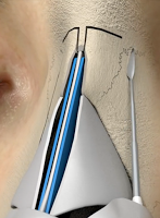 鼻骨截骨術-朝天鼻,蒜頭鼻,韓式隆鼻,隆鼻手術