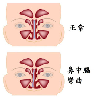 鼻中隔整形術-朝天鼻,蒜頭鼻,韓式隆鼻,隆鼻手術