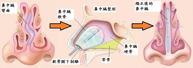 鼻中隔整形術-朝天鼻,蒜頭鼻,韓式隆鼻,隆鼻手術