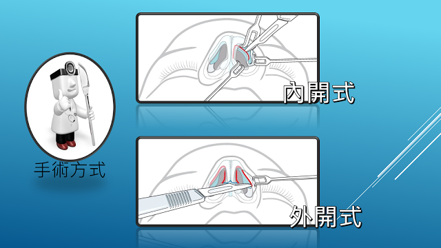 朝天鼻,蒜頭鼻,韓式隆鼻,隆鼻手術