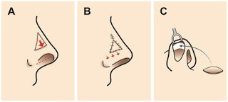 鼻整整形手術 V-Y flap + skin graft