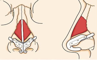 鼻整整形手術  Lateral crural strut  