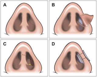 鼻整整形手術 Vestibular V-Y flap