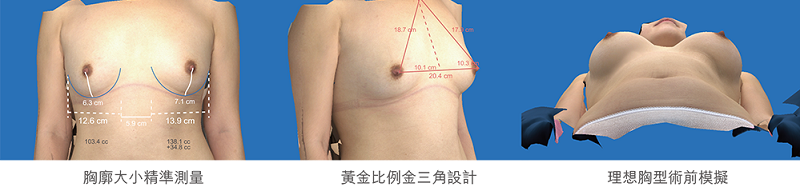 大小胸的問題_自體脂肪隆乳手術