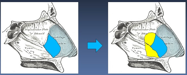 Septal osseocartilaginous graft (SOCG) 