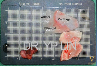 軟硬骨合併的鼻中膈植體SOCG及耳軟骨