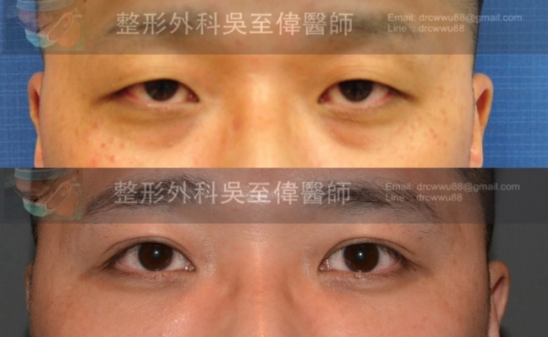 割雙眼皮,提眼瞼肌手術
