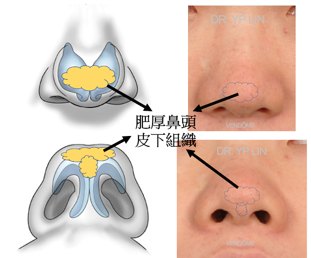 林彥斌醫師,隆鼻,鼻頭脂肪墊太厚