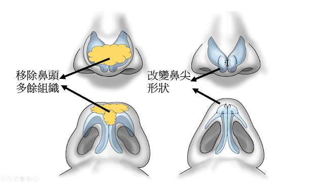 林彥斌醫師,隆鼻,鼻頭 鼻頭肉太多改善方式