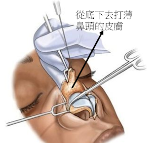 林彥斌醫師,隆鼻,鼻頭