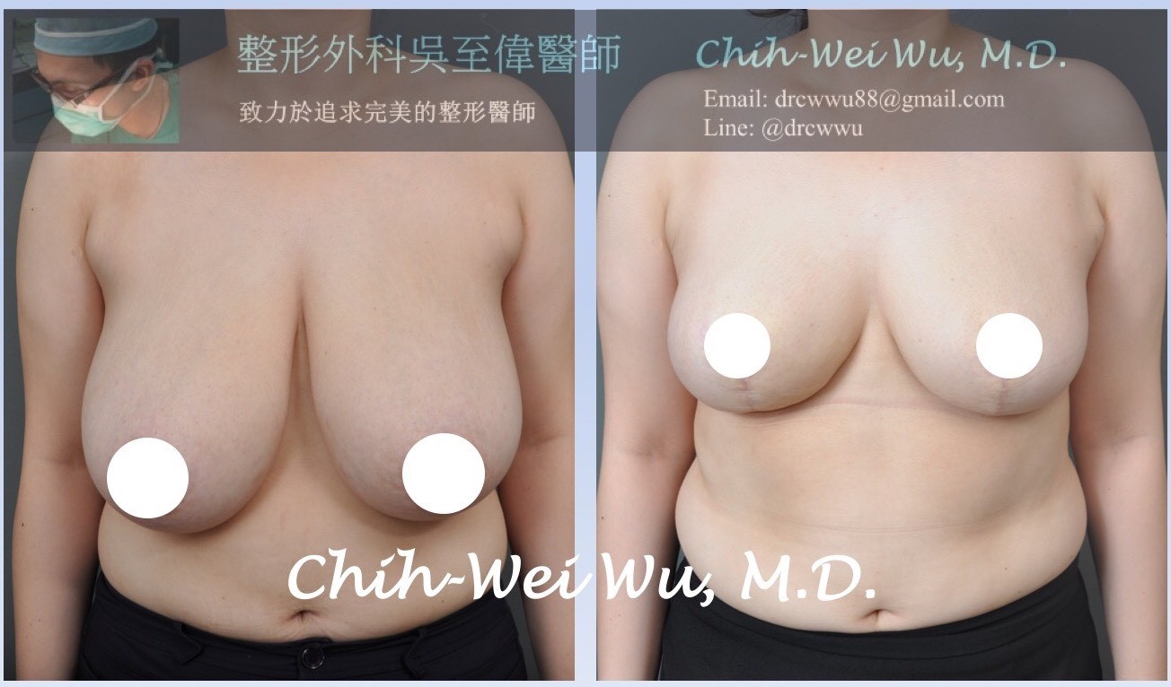 縮乳,縮胸,吳至偉醫師,凡登整形外科診所