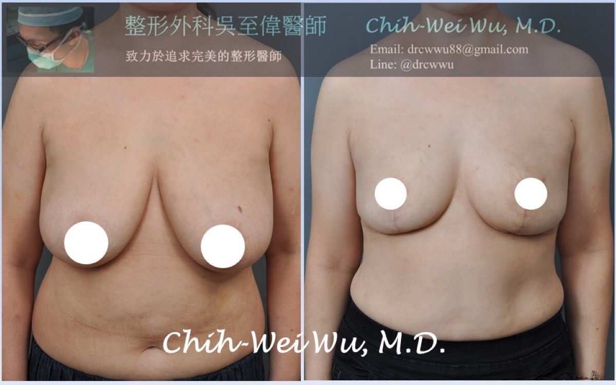 縮乳,縮胸,吳至偉醫師,凡登整形外科診所