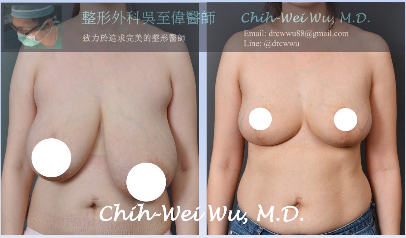 縮乳,縮胸,吳至偉醫師,凡登整形外科診所