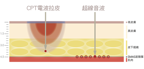 電波,音波,電波拉皮,音波拉皮,雙波拉皮