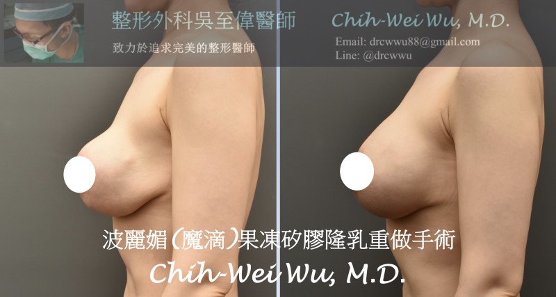 motiva,魔滴,魔滴隆乳,果凍矽膠隆乳